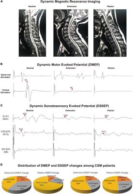 Spinal Cord Parenchyma Vascular Redistribution Underlies Hemodynamic and Neurophysiological Changes at Dynamic Neck Positions in Cervical Spondylotic Myelopathy